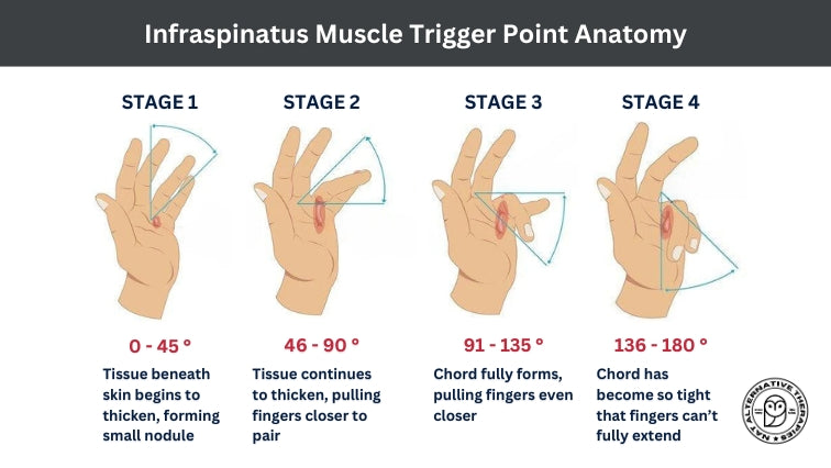 Dupuytren’s Contracture - Conservative Treatment Options