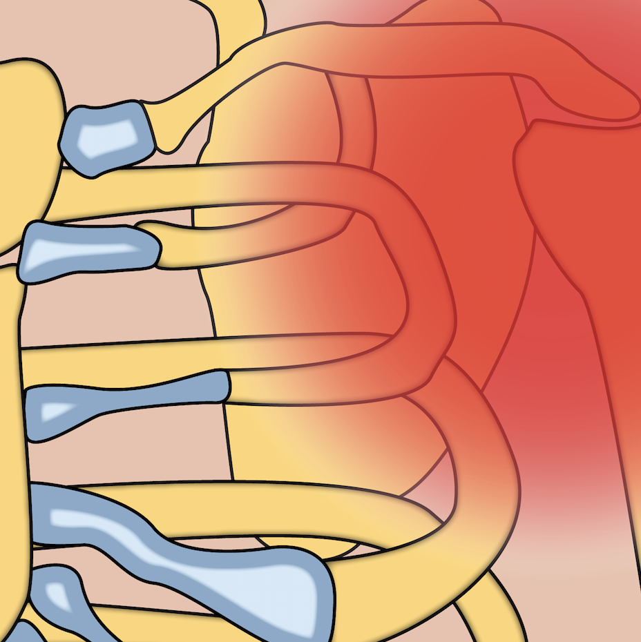 Shoulder Impingement or a True Frozen Shoulder?