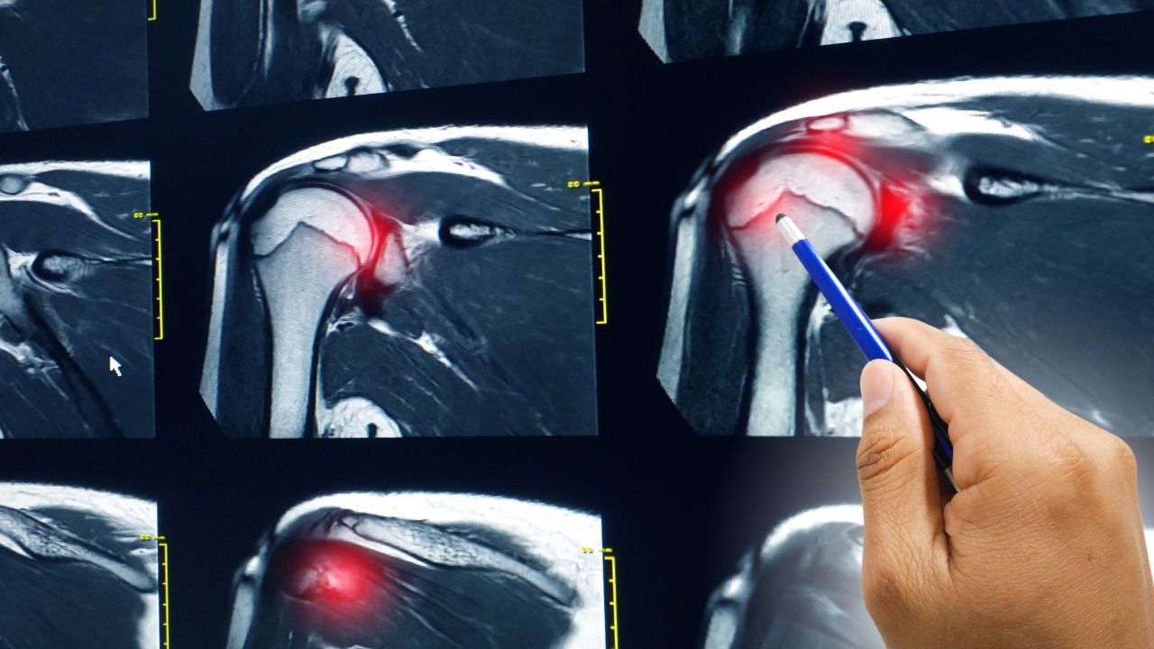 Sports Massage Therapy for Shoulder Muscles: A Vital Component of Rehabilitation and Recovery