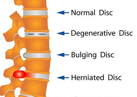 Herniated Disc Illustration