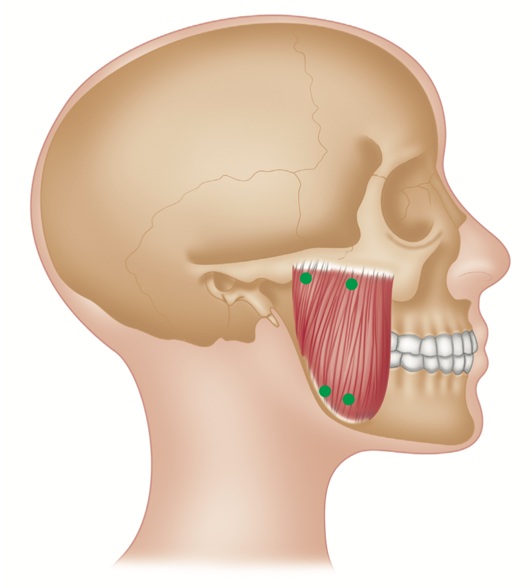 How To Find Trigger Points in the Masseter (Ear and Jaw Pain)