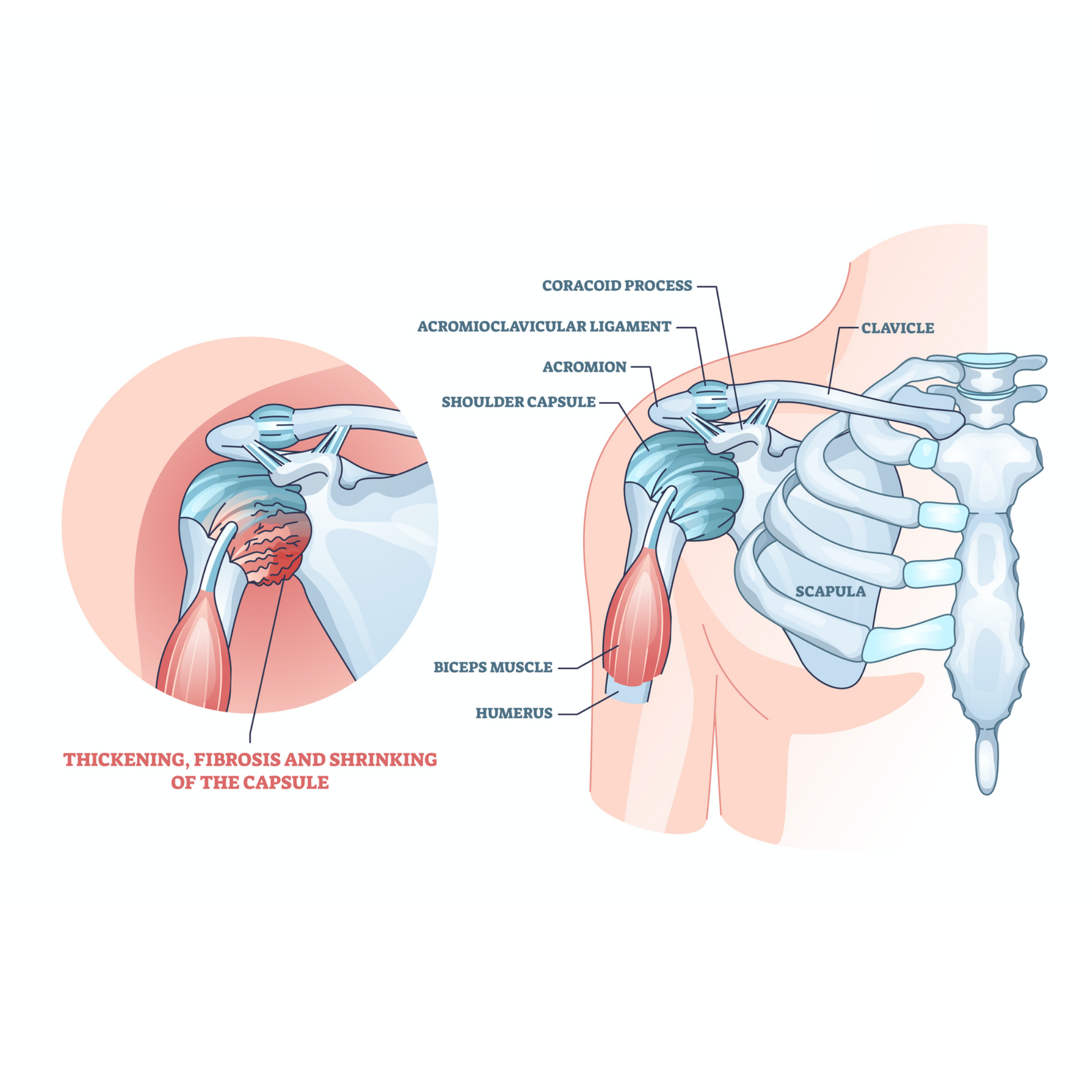 Trigger Point Therapy - Defining a Frozen Shoulder