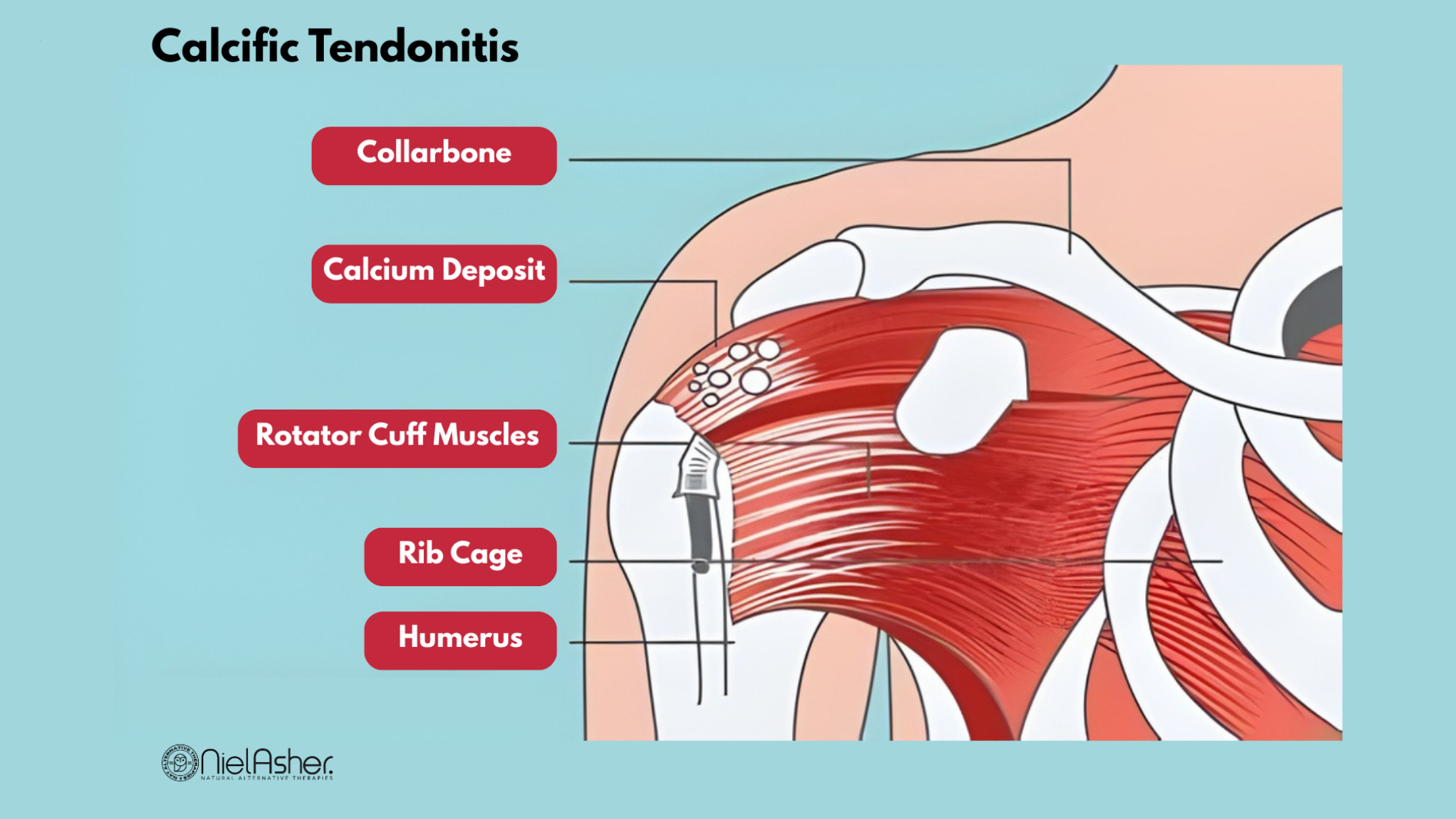 Treating Calcific Tendonitis