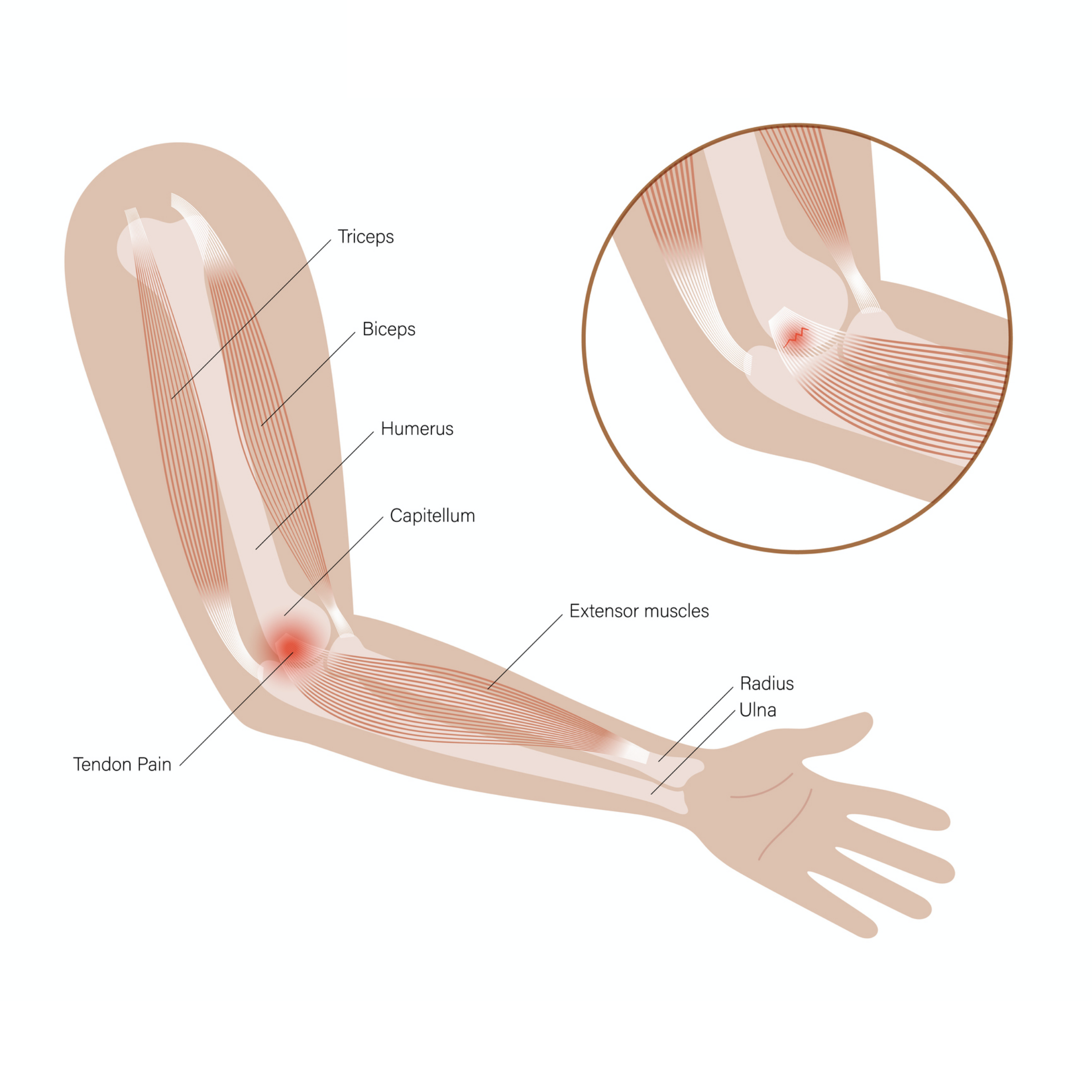 Treating Golfer's Elbow - Trigger Point Therapy