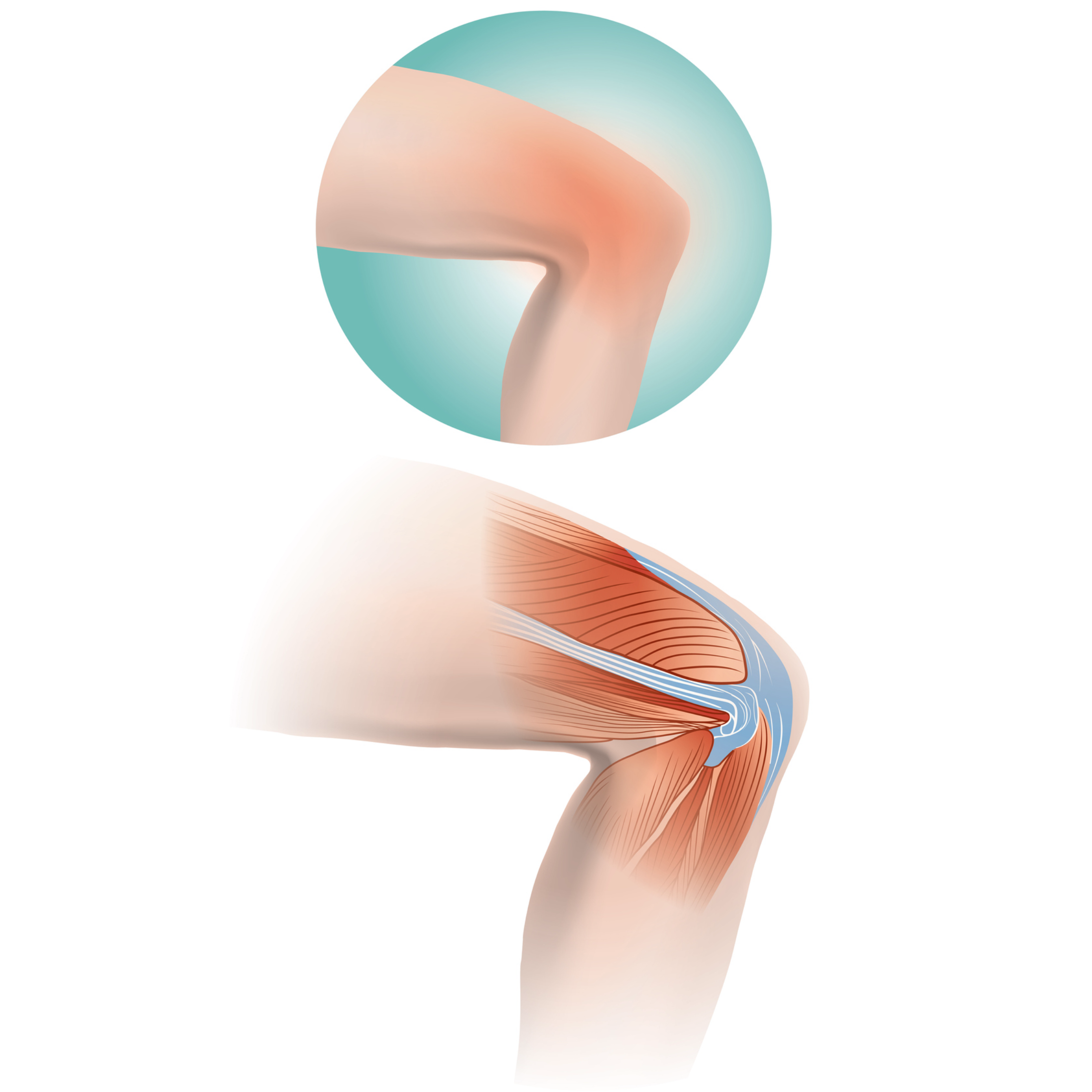 Iliotibial Band Syndrome