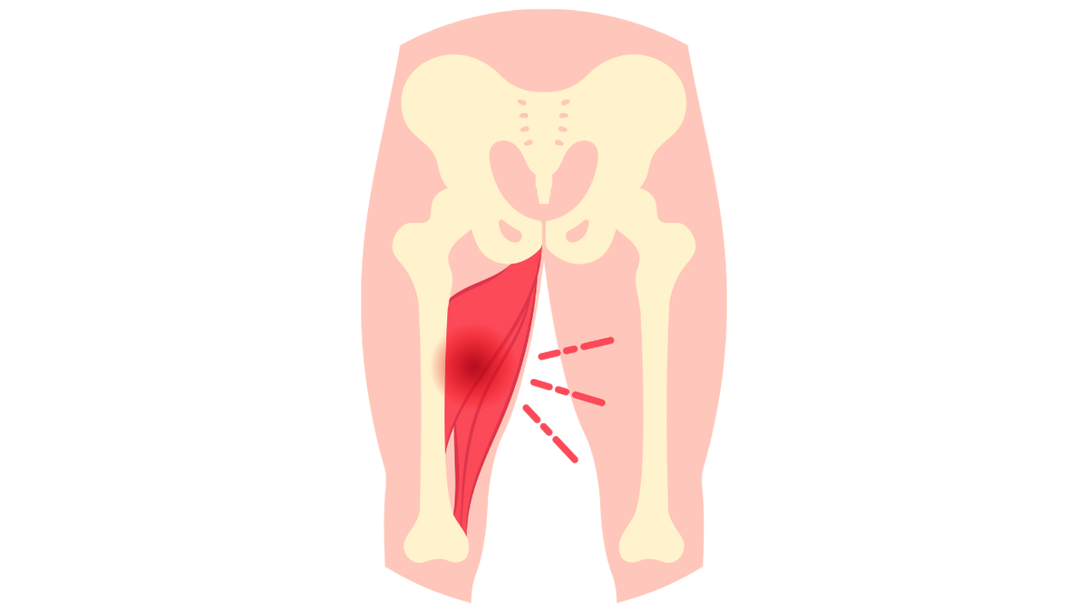 Sports Injury Bulletin - Anatomy - Tensor fascia latae: unraveling