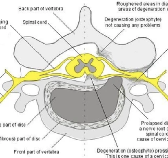 Trigger Point Therapy - Cervical Spondylosis