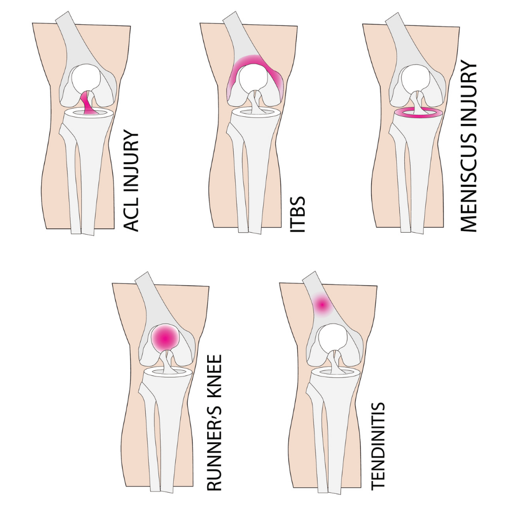 Runners Knee - Overview and Considerations