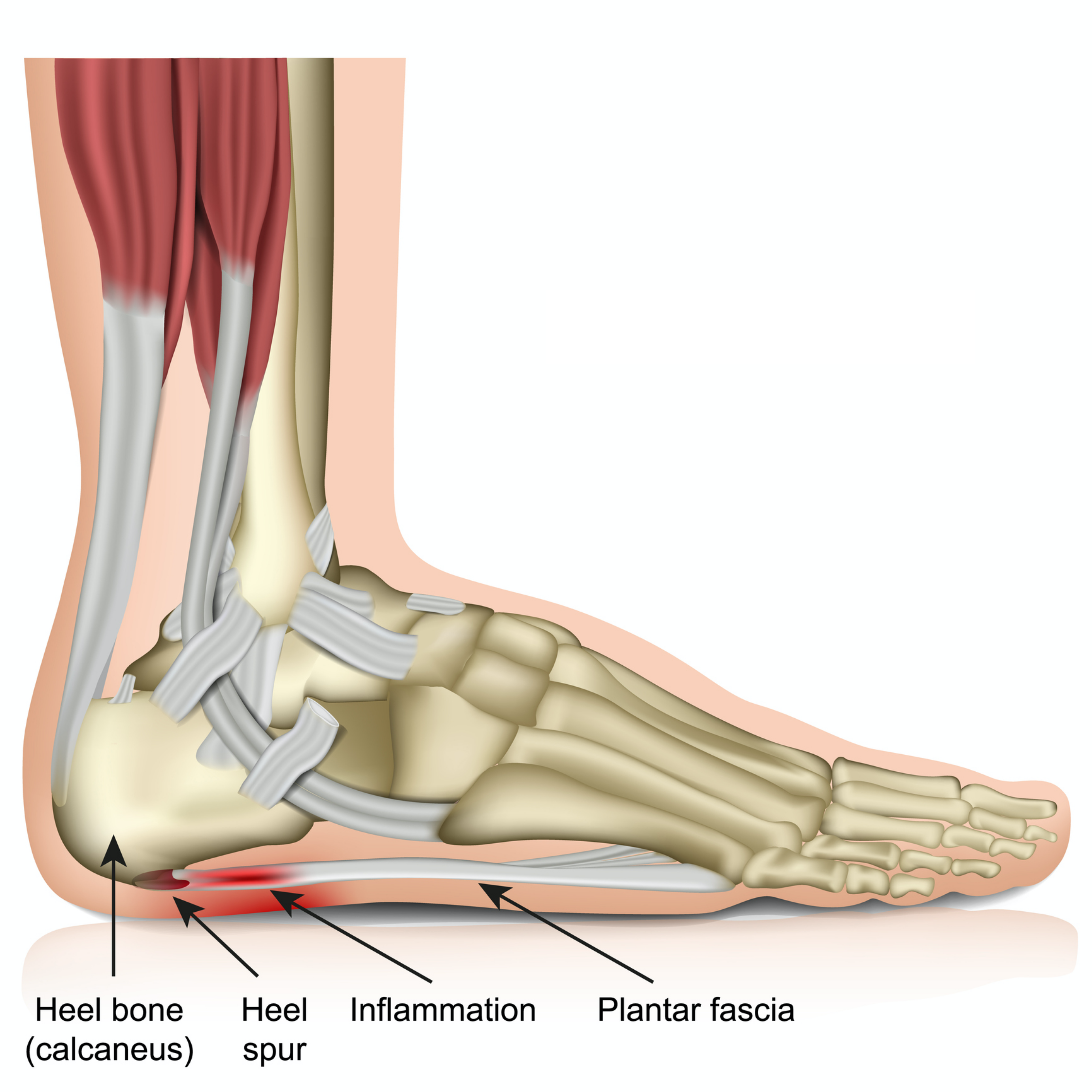 How to Treat Plantar Fasciitis