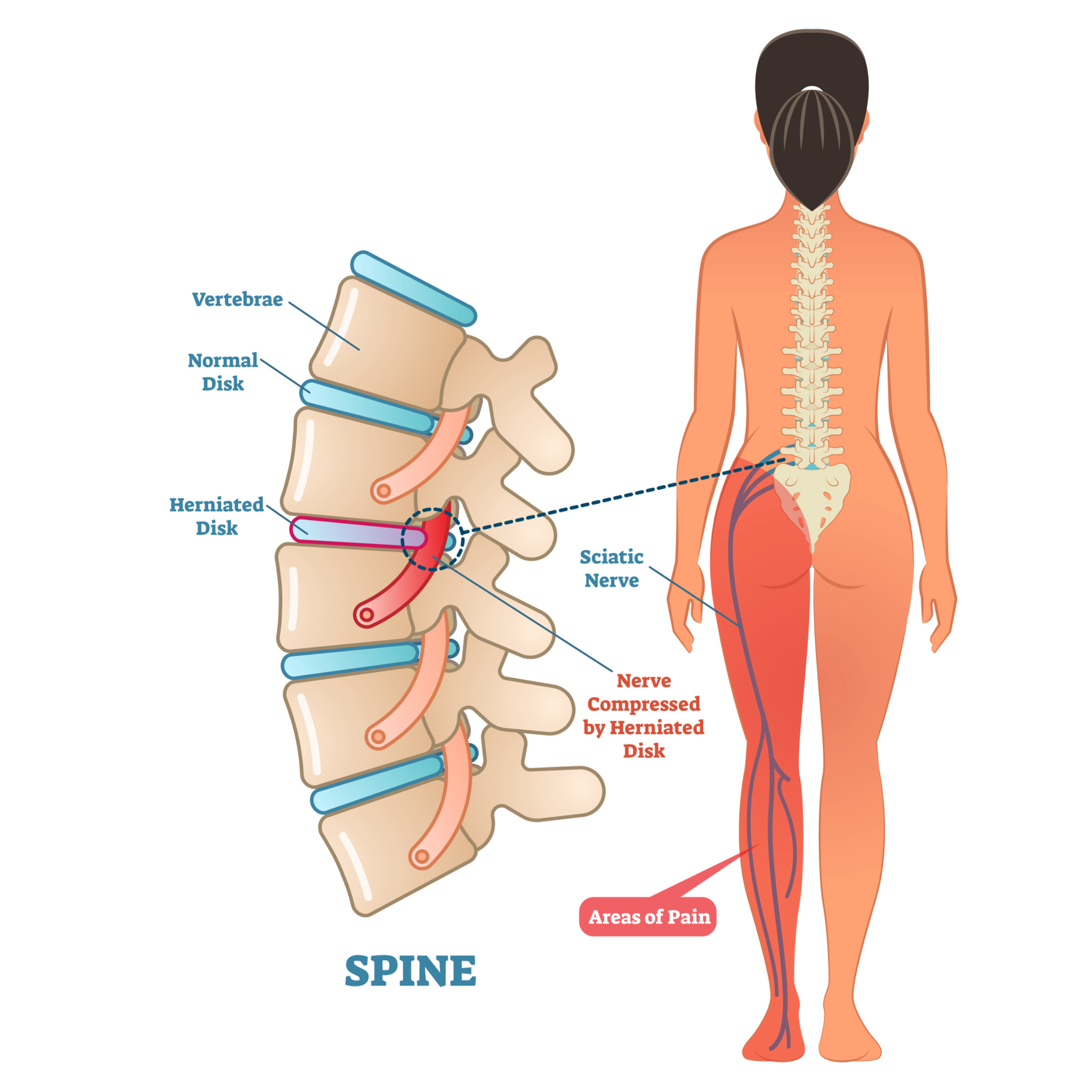 Sciatic Pain