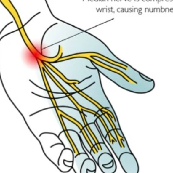 Carpal Tunnel Syndrome | Soft Tissue Therapy | Trigger Point Release