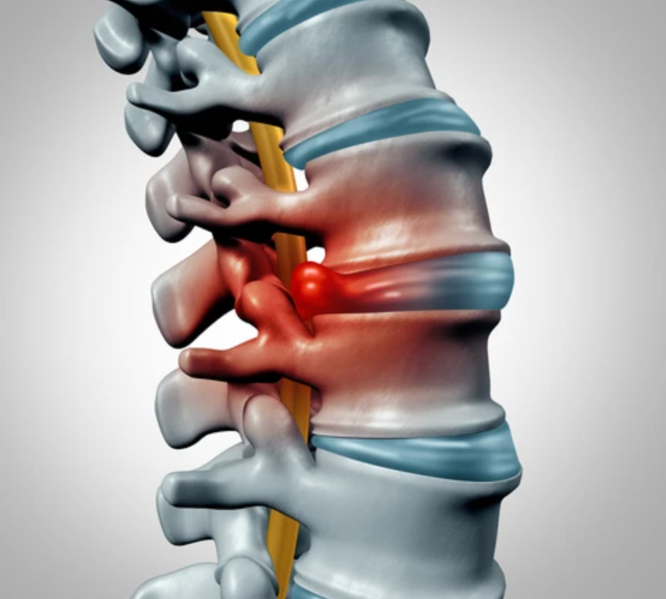 Common Causes of Chronic Lower Back Pain