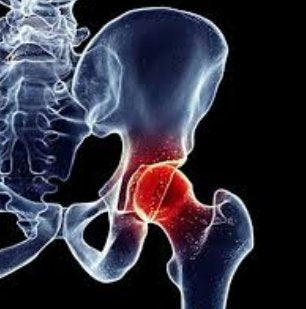 Trigger Point Therapy - Treating Osteoarthritis of the Hip
