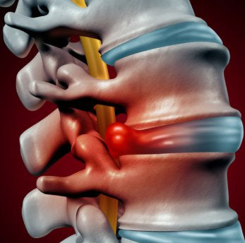 Trigger Point Therapy - Treating a Bulging Disc