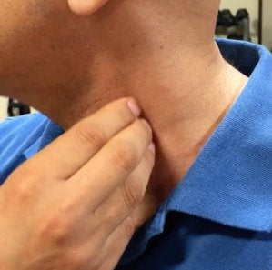 Thoracic Outlet Syndrome - Scalenes and Pec Minor Treatment