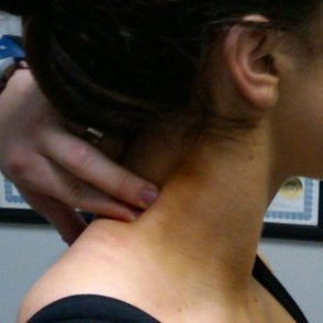 Levator Scapulae Trigger Points - Treatment