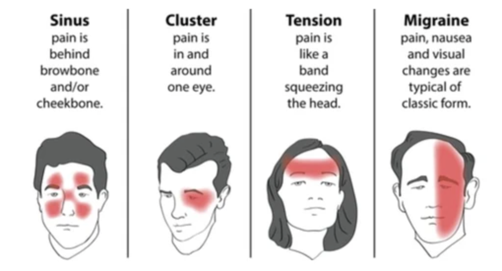 Treating Migraine Headaches - Trigger Point Therapy