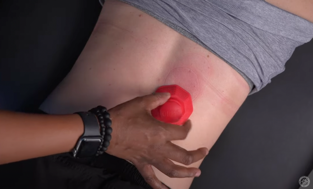 Why the Continuing Rise in Popularity of Cupping Therapy?