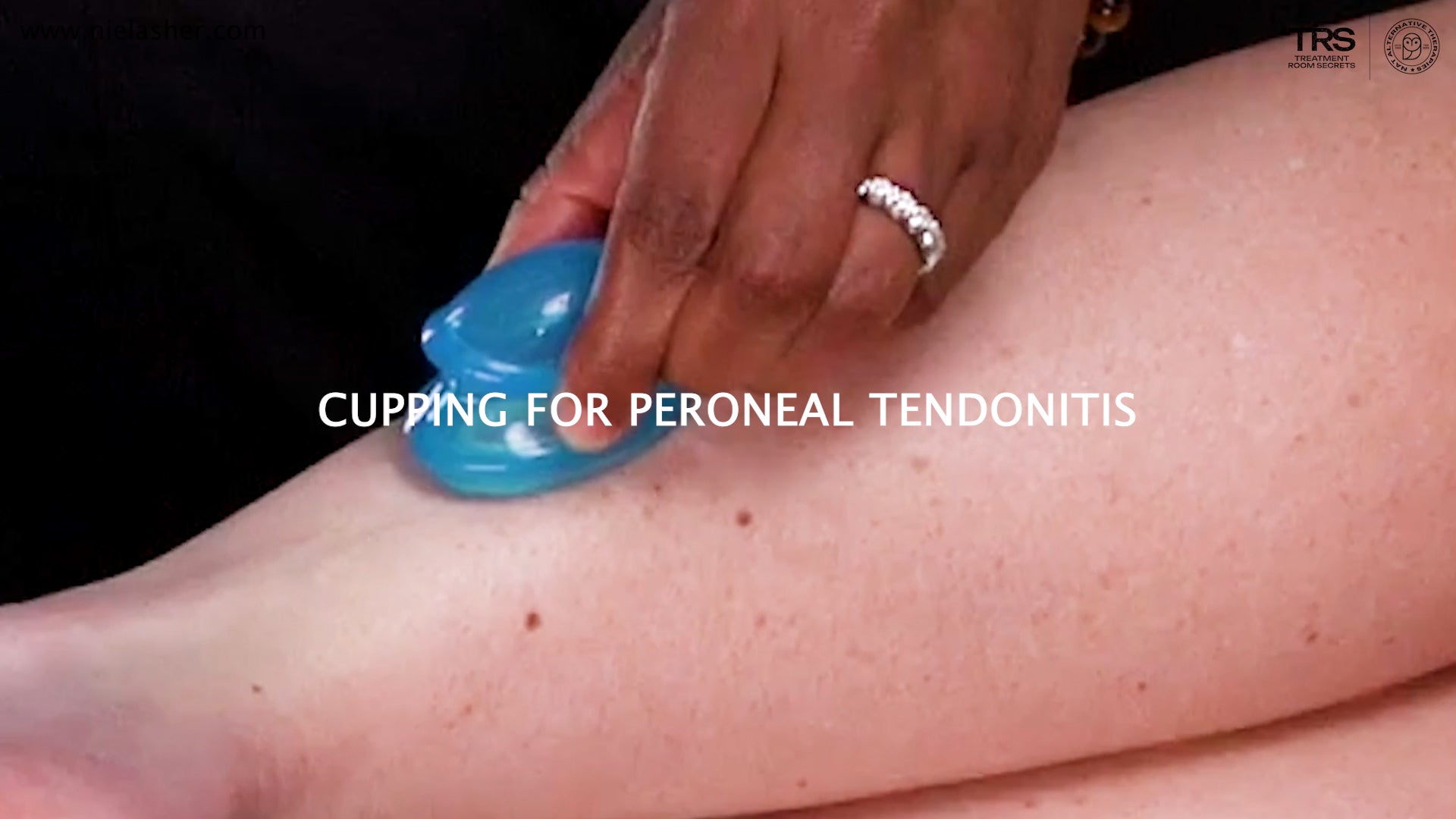 The Peroneal Muscles and Peroneal Tendonitis