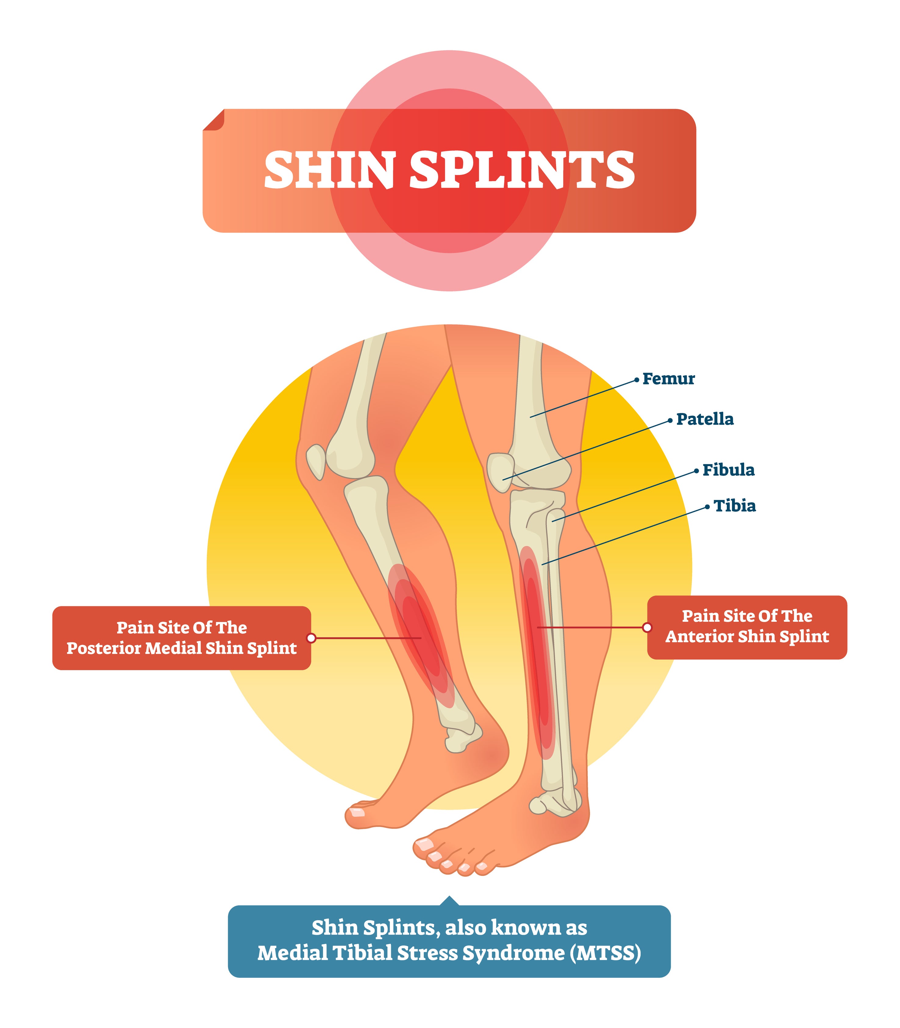 Soft Tissue Therapy for Shin Splints (MTSS)