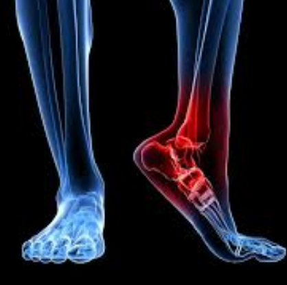 Trigger Point Therapy - Treating Achilles Tendinitis