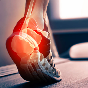 Achilles Tendinitis - Self Help