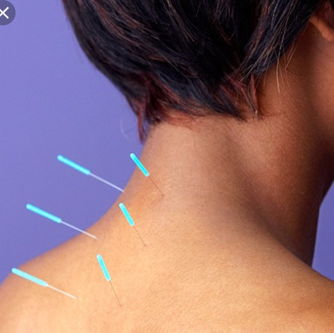 Dry Needling or Acupuncture?