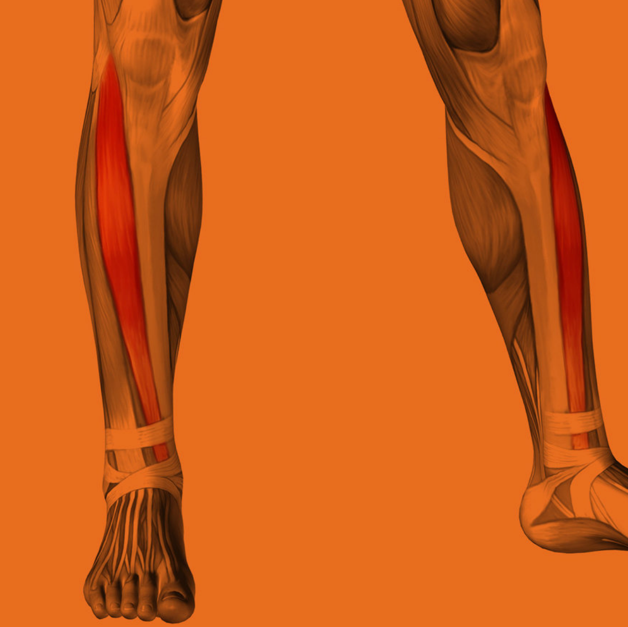 Tibialis Anterior - "Anterior Compartment Syndrome"