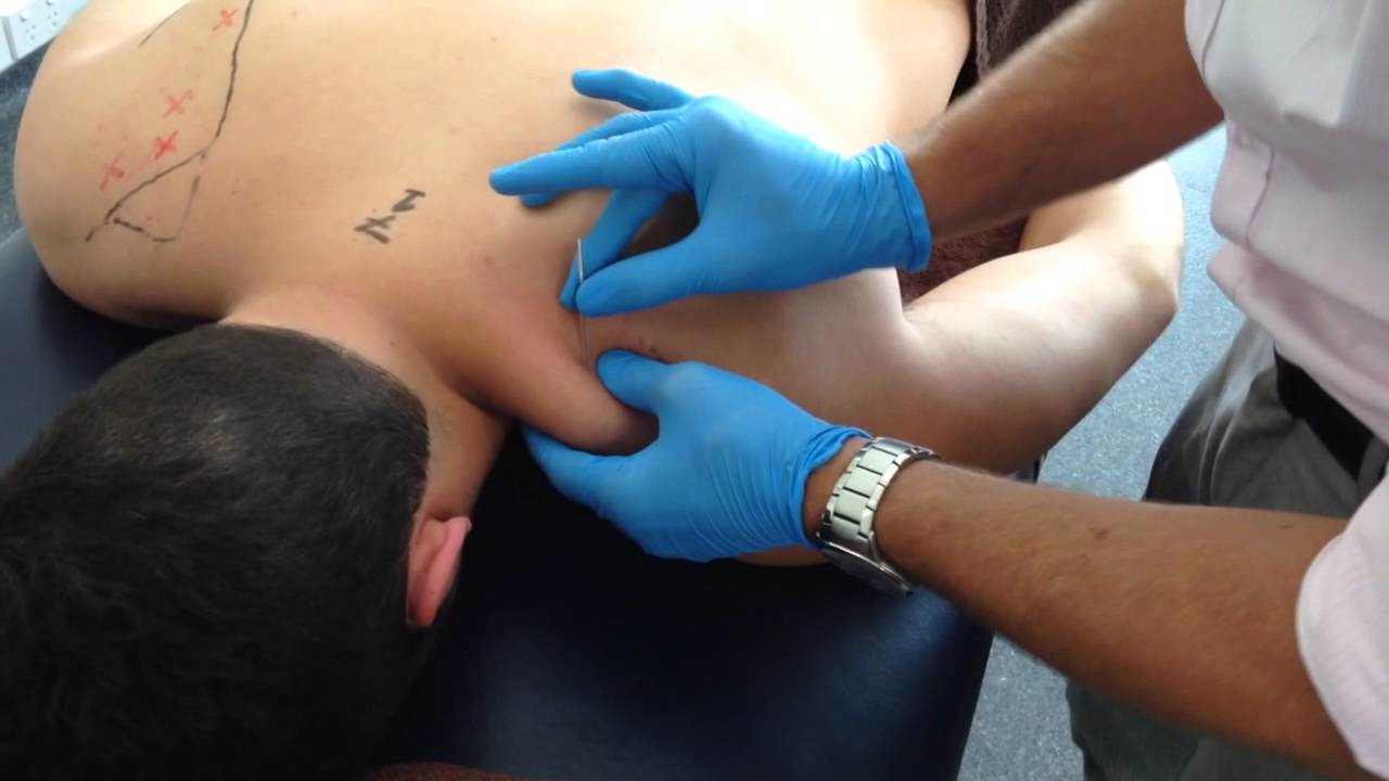 Trigger Point Needling | Treating the Trapezius