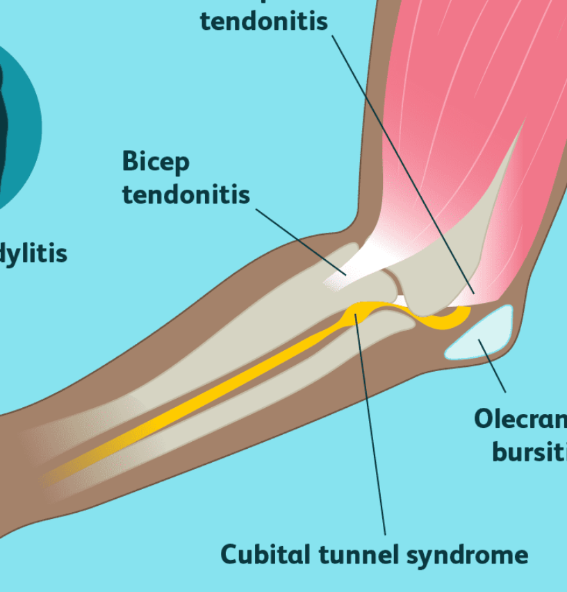 cubital tunnel syndrome