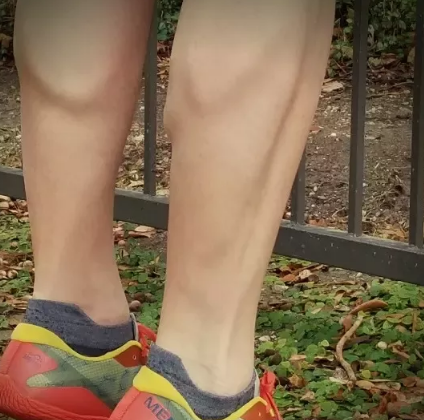 Treating Gastrocnemius