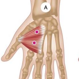 Painful and Stiff Thumb - Arthritis or Trigger Points?