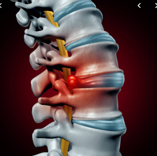 Trigger Point Therapy - Treating a Herniated Disc