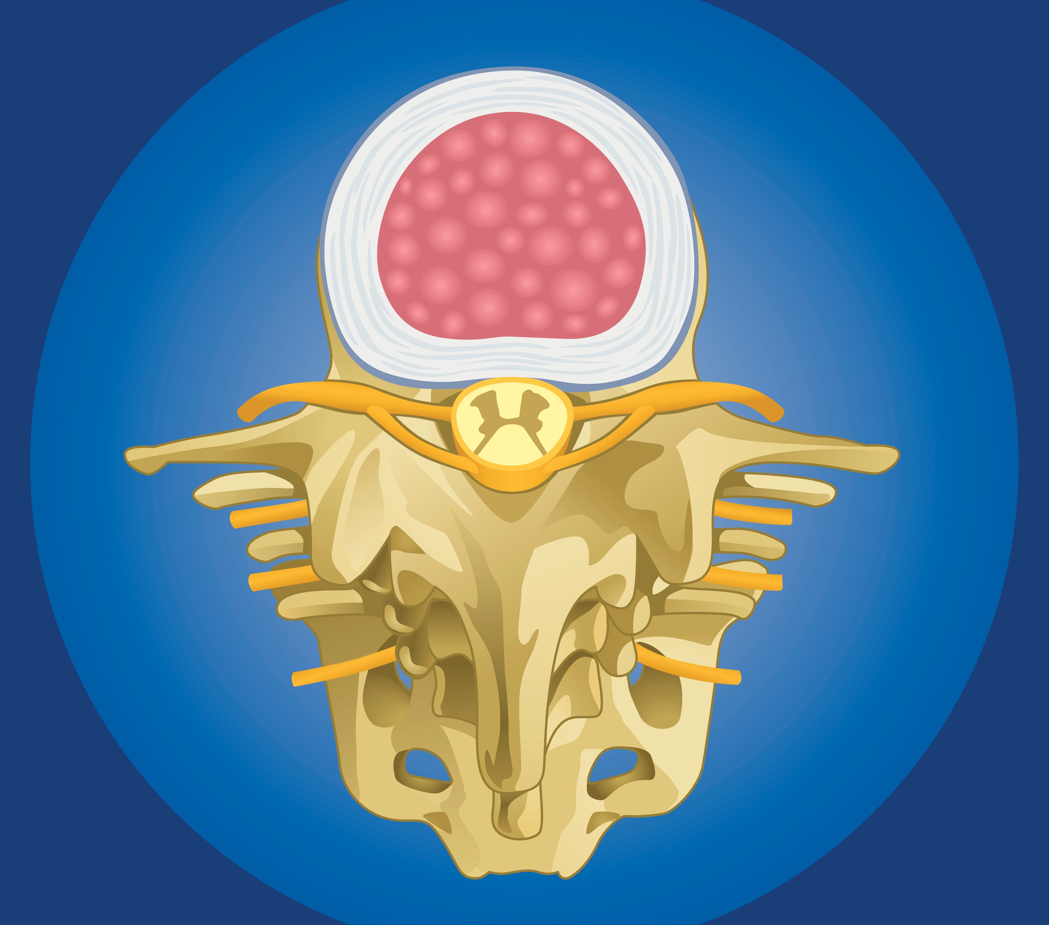 Low Back Pain | Key Structures | Facet Joint Syndromes