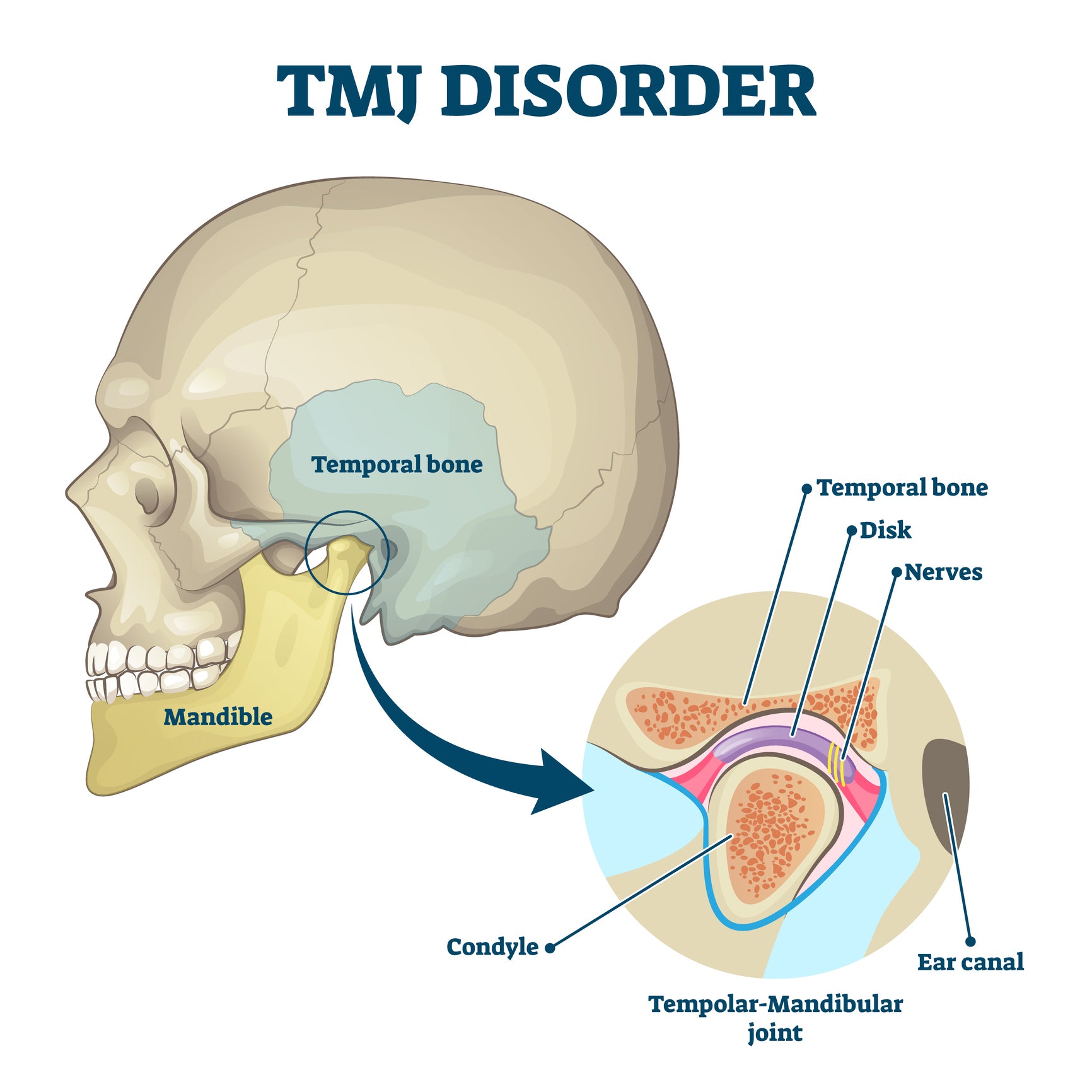 Treating Temporomandibular Joint Disorders (TMJ / TMJD)