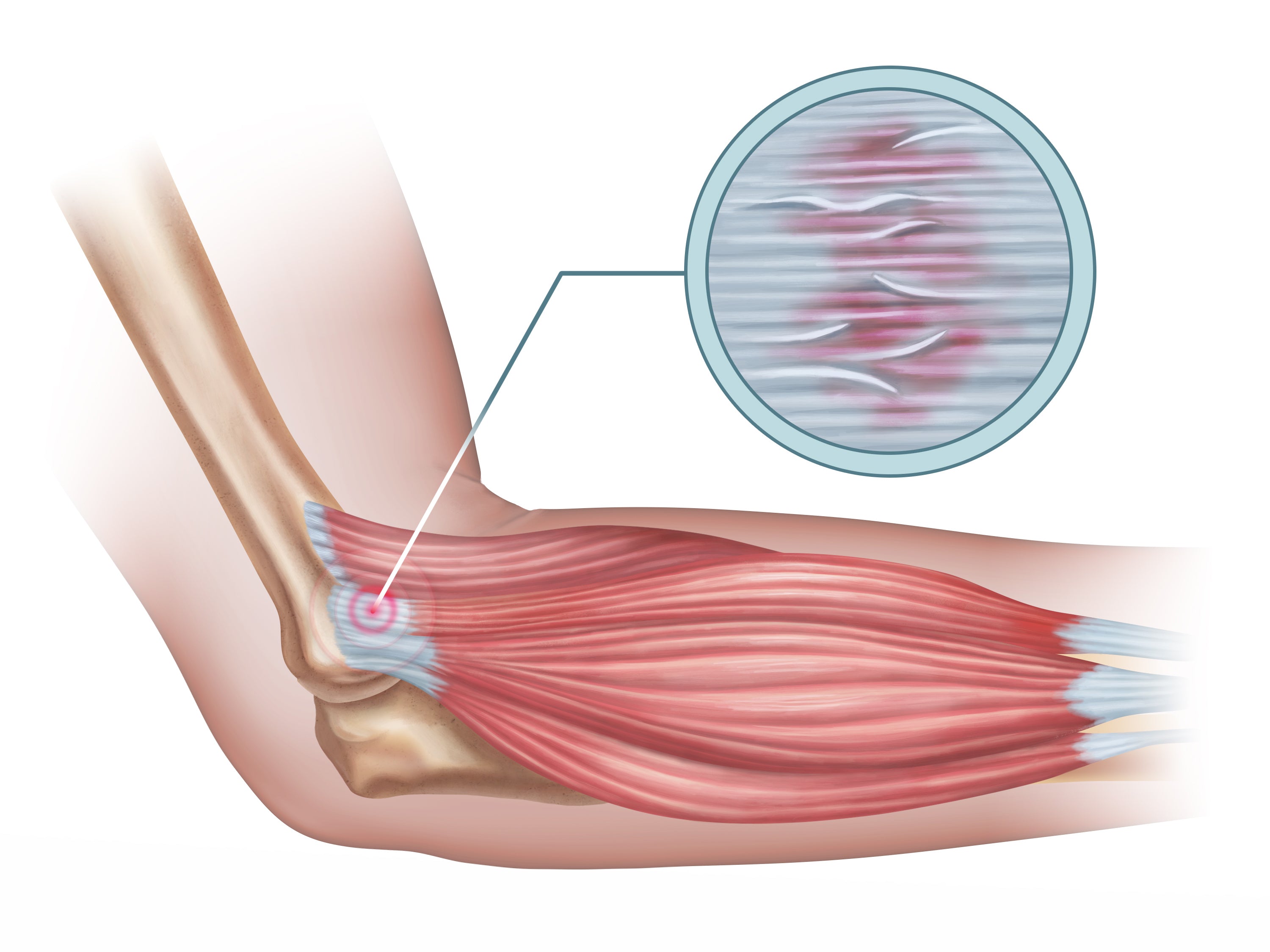 Treating Tennis Elbow