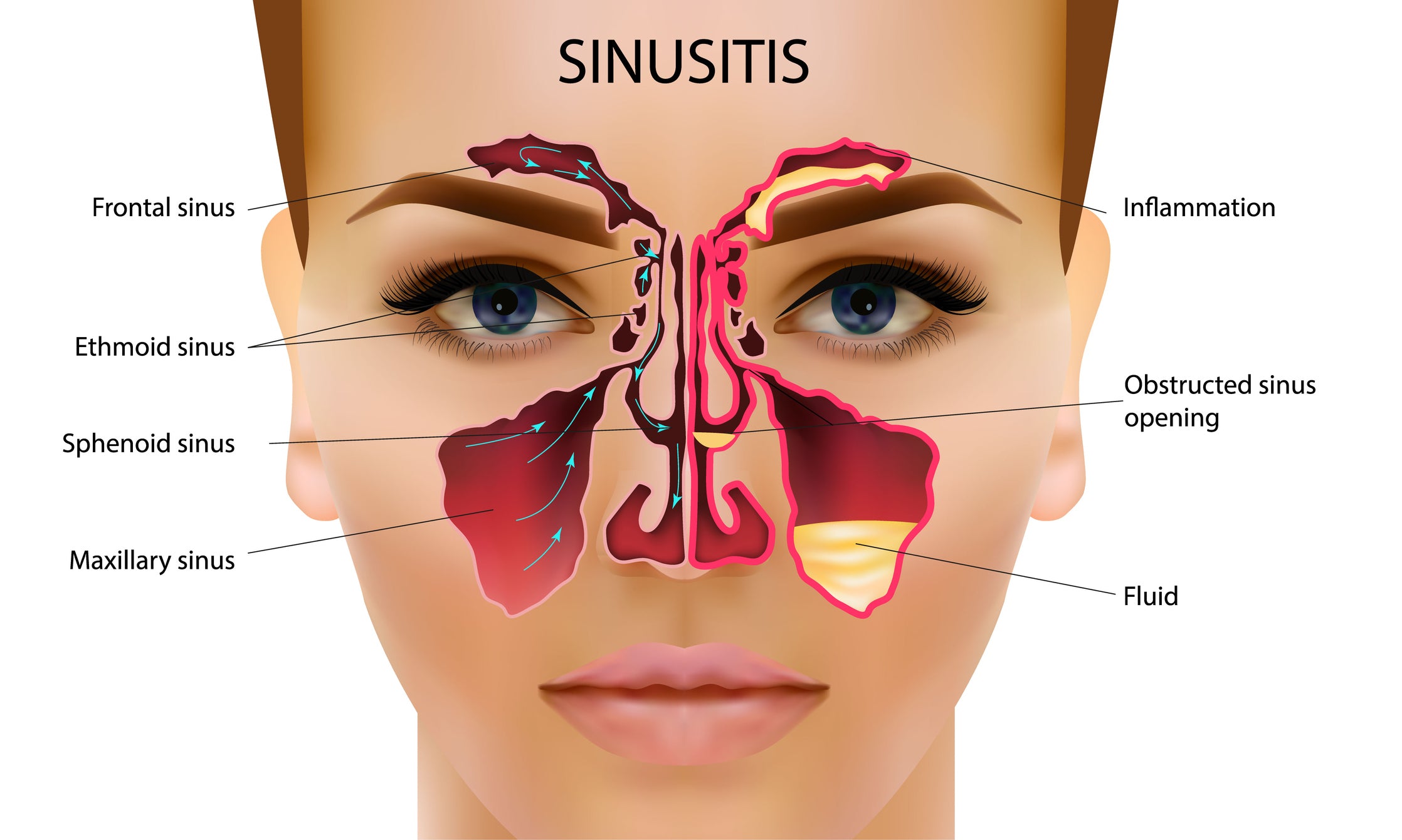 sinusitis image