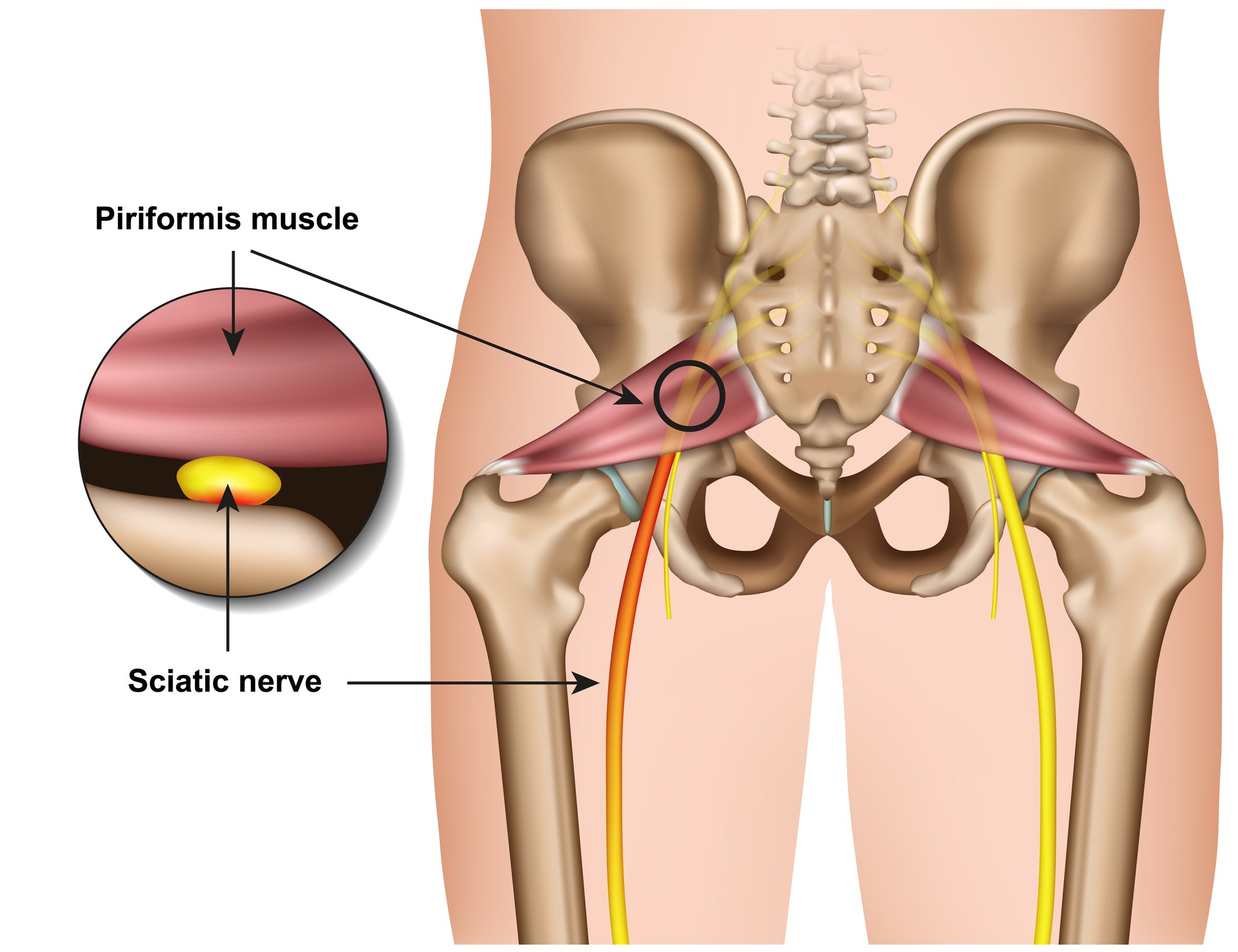 Piriformis syndrome