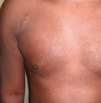 Trigger Point Therapy - Treating Pectoralis Major