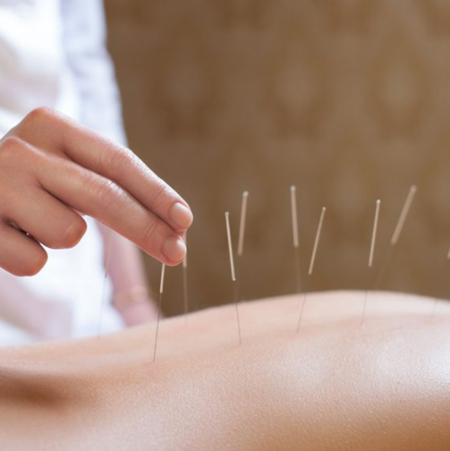 Dry Needling - Iliocostalis and Longissimus