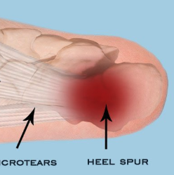 Trigger Point Therapy - Heel Pain and Night Cramp