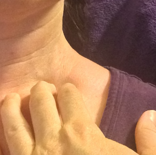 Trigger Point Therapy - Treating Scalenes Trigger Points