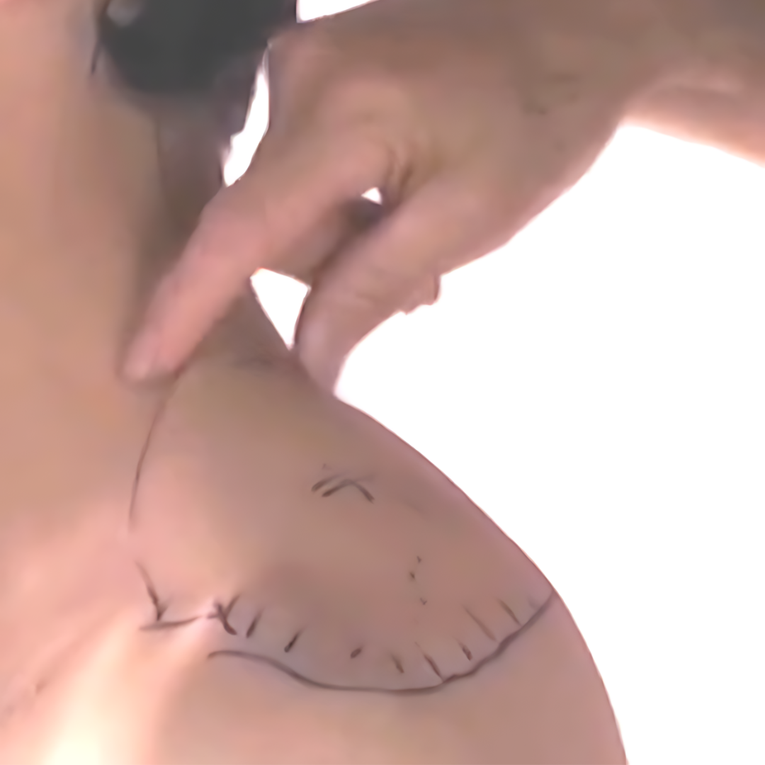 Tension Headache and Trigger Points (4 hrs)