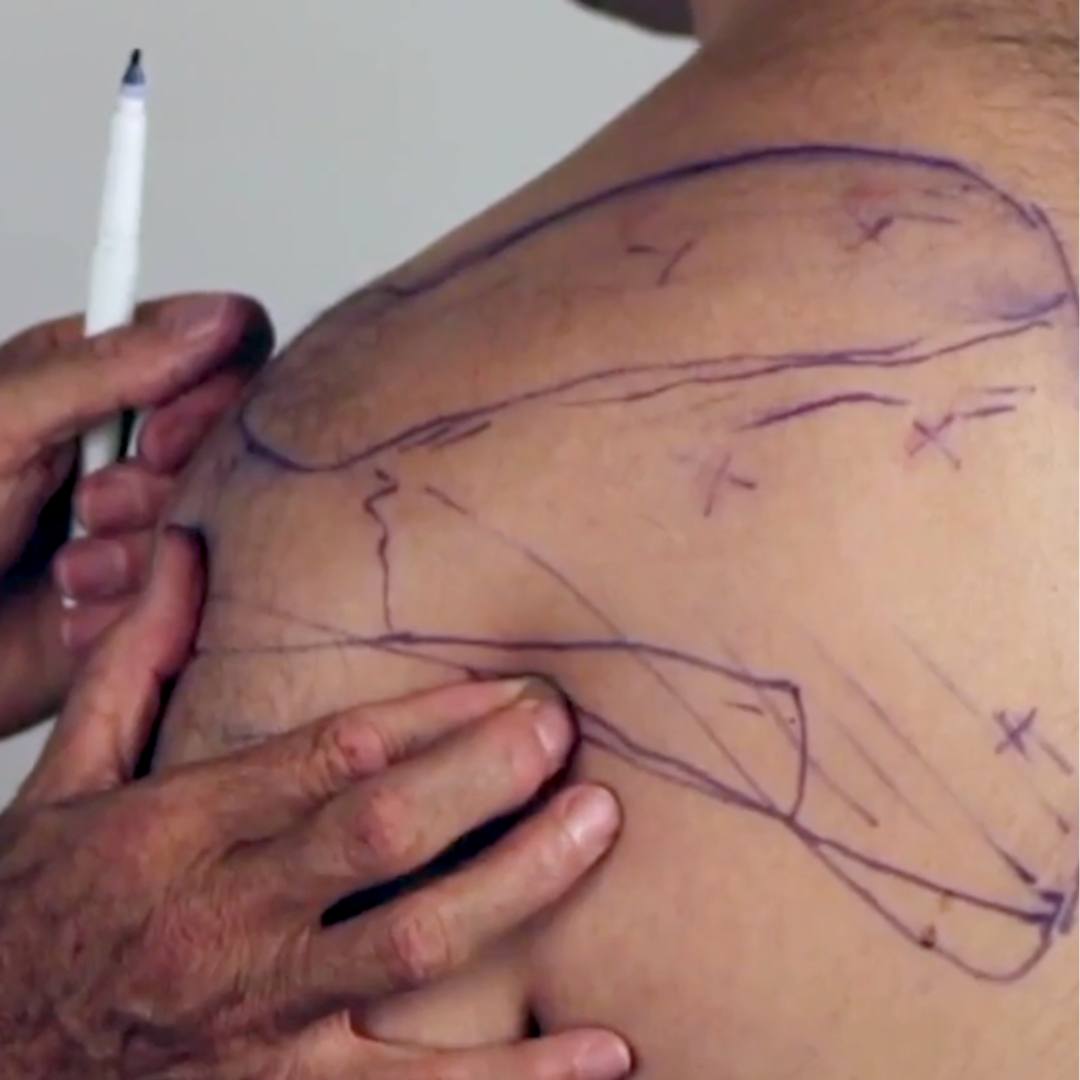 NAT Treating the Rotator Cuff (4 hrs)