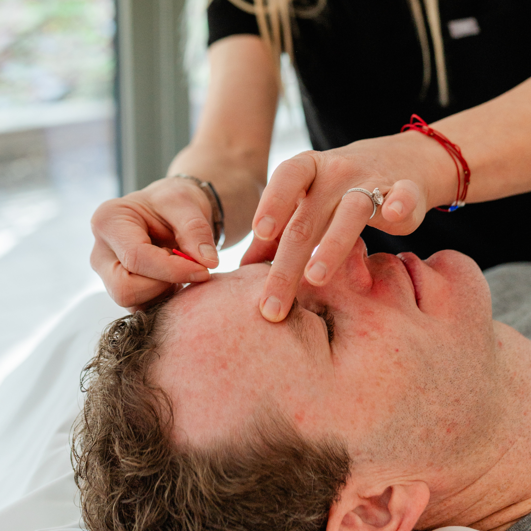 Foundation in Acupuncture (Level 2)