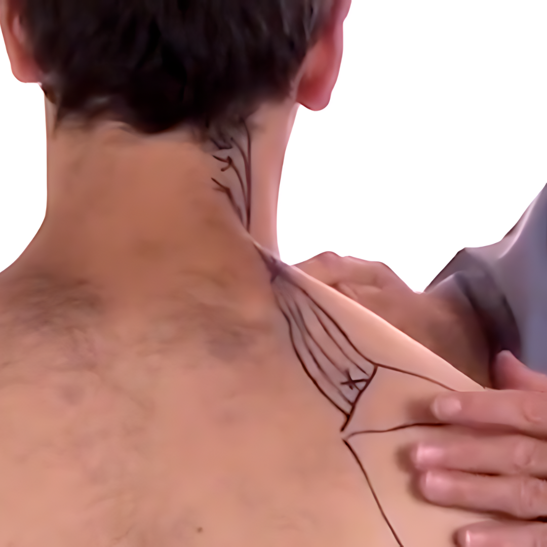 Tension Headache and Trigger Points (4 hrs)