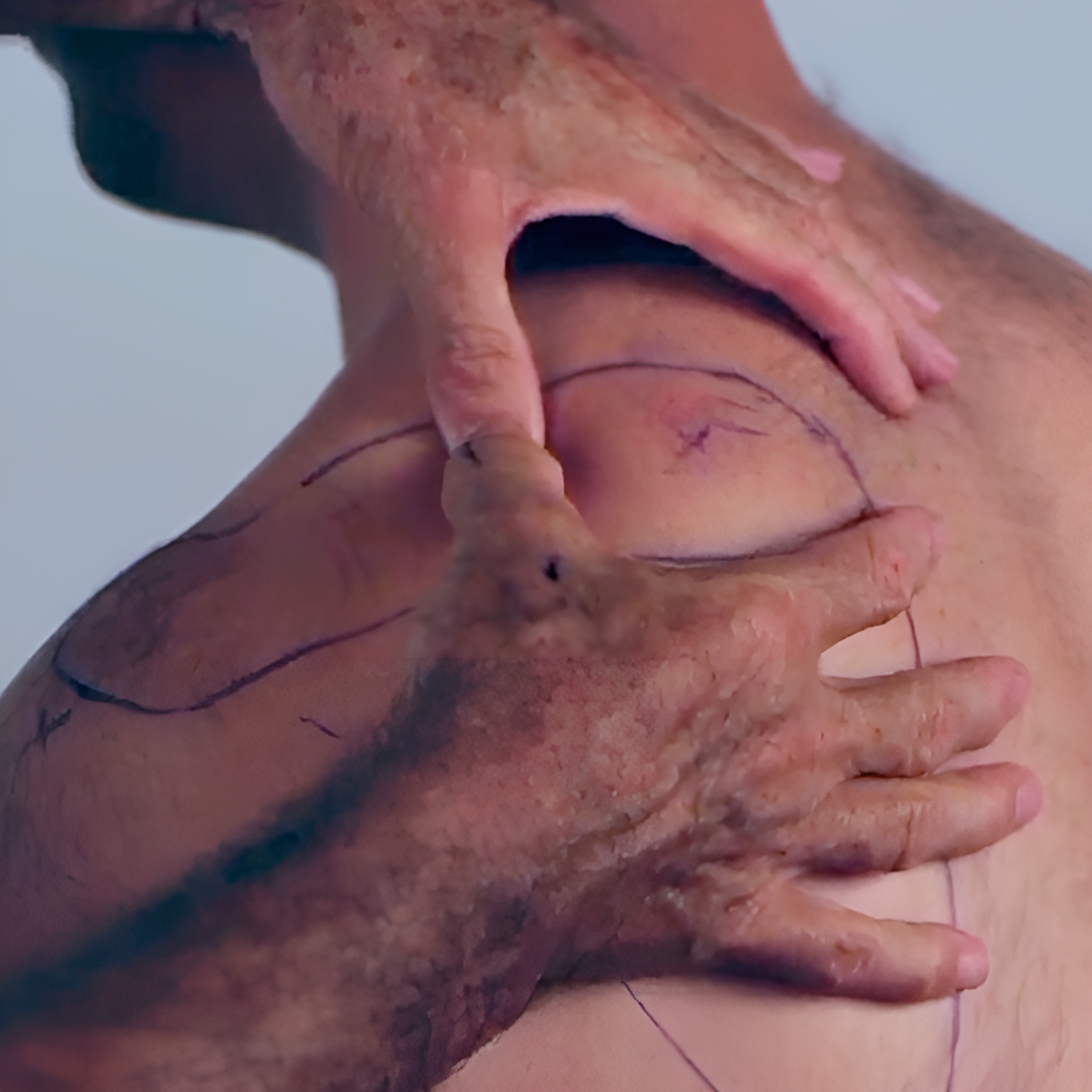 NAT Treating the Rotator Cuff (4 hrs)