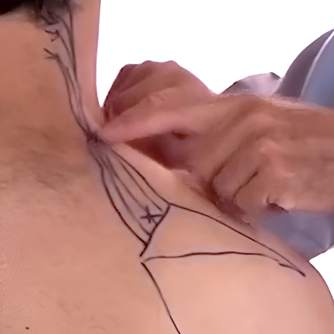 Tension Headache and Trigger Points (4 hrs)