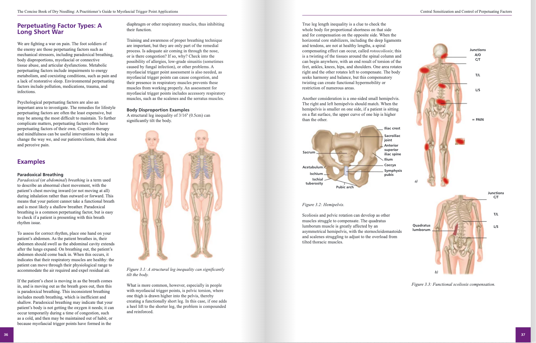 The Concise Book of Dry Needling