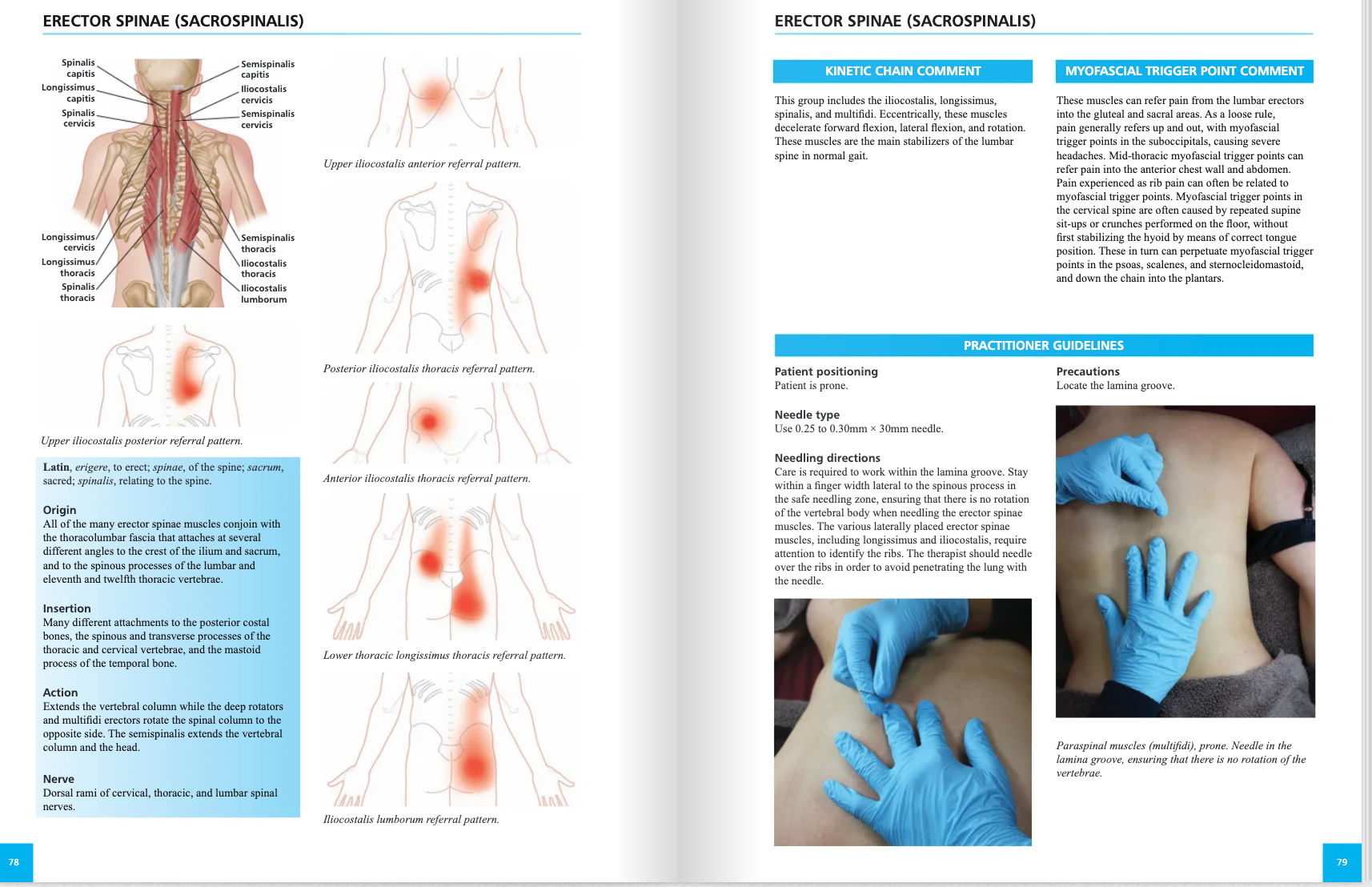 The Concise Book of Dry Needling